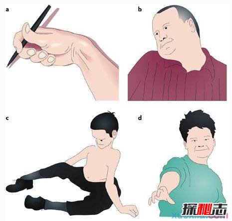 中國世界首例舞蹈豬,亨廷頓氏舞蹈癥是什么??？